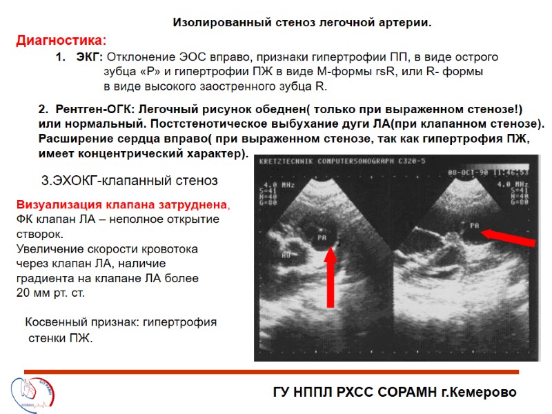 ГУ НППЛ РХСС СОРАМН г.Кемерово Изолированный стеноз легочной артерии. Диагностика: ЭКГ: Отклонение ЭОС вправо,